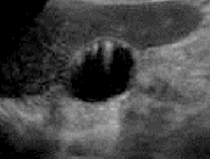 <ul><li><p><span style="background-color: transparent;">Type of reverberation artifact</span></p></li><li><p><span style="background-color: transparent;">Small focal reflectors cause a narrow reverberation artifact</span></p></li><li><p><span style="background-color: transparent;">Often seen with and useful in the diagnosis of:</span></p><ul><li><p><span style="background-color: transparent;">Adenomyomatosis/cholesterolosis of the gallbladder (GB)</span></p></li><li><p><span style="background-color: transparent;">Colloid thyroid nodules</span></p></li></ul></li></ul><p></p>