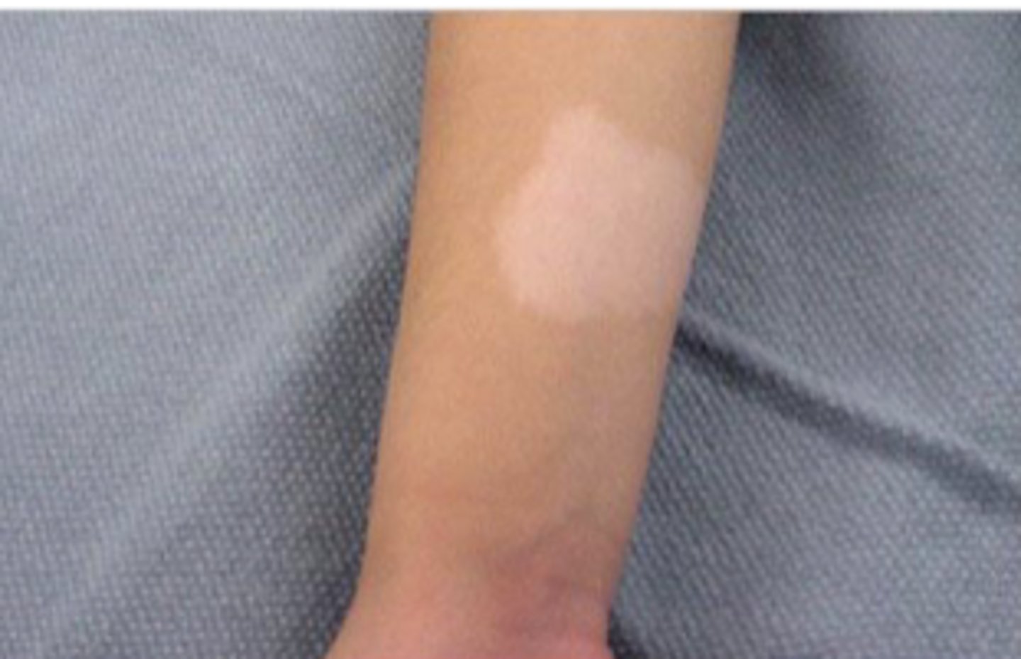 <p>lesion measuring less than 2 cm in diameters. Not raised nor depressed</p>