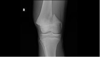 <p><strong>Refer to the figure. </strong>Radiographic assessment of a fractured bone must include:</p><p>a) The routine radiographic exam for the most distal joint</p><p>b) An AP view of the contralateral limb to assess normal values</p><p>c) Two views at right angles to each other</p><p>d) The routine radiographic exam for the most proximal joint</p>