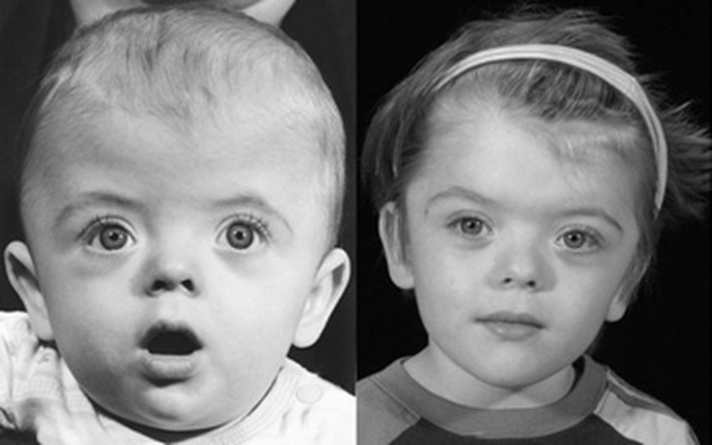 <p>•Abnormally shaped head</p><p>•Wide set eyes</p><p>•Flattened cheek bones</p><p>•Mild hand/feet abnormalities</p><p>•Most have normal intellect</p>