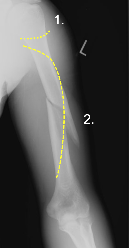 1. Surgical neck (1)
2. Midshaft spiral fractures (2) 
3. Nerves (in yellow) pass along the bone and can be damaged by these two fractures
4. MAY lead to permanent upper limb dysfunction