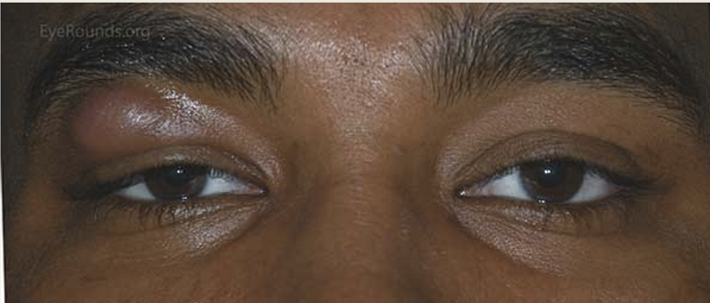 <p>Chalazion, eyelid inflammation, or edema</p>