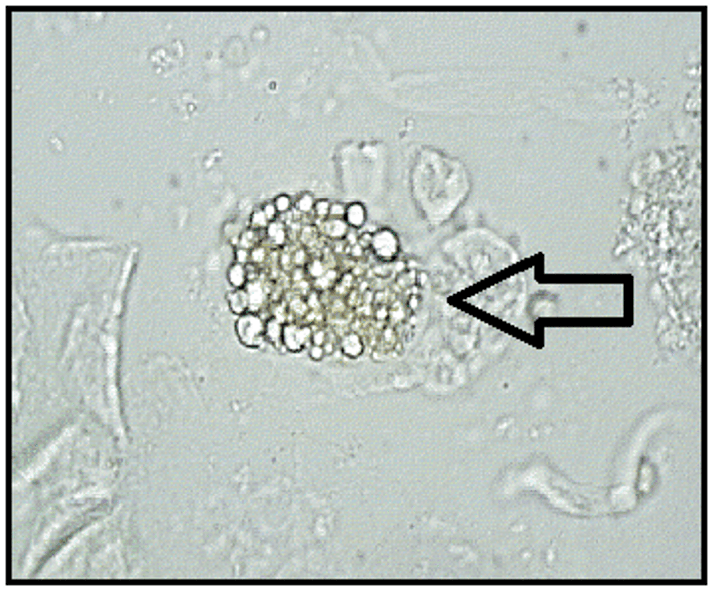 <p>-RTE cells that absorb lipids</p><p>-highly retractile RTE cells</p><p>-reported as average number per hpf</p><p>-correlation= clarity, blood, protein, and free fat droplets/ fatty casts</p>