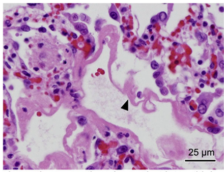 <p>This picture shows lung tissue that interstitial pneumonia and edema with a hyaline membrane - what coccidia causes this?</p>