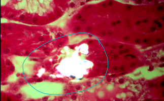 <ul><li><p><strong><u>Alcohol dehydrogenase → the problem (1st-2nd metabolism) then moves to Lactate dehydrogenase (after glycolate) **</u></strong></p></li></ul><ul><li><p><span style="background-color: transparent;"><strong>Et: </strong>AKI; <u>glycolate</u>/glyoxylate → Ca oxalate crystals : causes obstruction intraluminal or intracellular  </span></p></li><li><p><span style="background-color: transparent;"><strong>Cs: </strong></span></p><ul><li><p><span style="background-color: transparent; color: blue;"><strong>Neuro (<12h) → intervene here</strong></span></p></li><li><p><span style="background-color: transparent; color: blue;"><strong>Cardio(12-24h) → intervene here </strong></span></p></li><li><p><span style="background-color: transparent; color: blue;"><strong> Renal (24-72h) → when the problem occurs</strong></span></p><ul><li><p><strong>profound oligo-anuric AIRF (almost always fatal once established)</strong></p></li></ul></li></ul></li></ul><ul><li><p><span style="background-color: transparent; color: blue;"><strong> oligo-anuric AIRF (fatal)</strong></span></p></li></ul><ul><li><p><span style="background-color: transparent;"><strong>Dt: <u>dilute urine, oxalate crystalluria, ↑ Anion Gap</u></strong><u>/OG, </u><strong><u>↓ Ca</u></strong><u>, </u><strong><u>progressive azotemia</u></strong></span></p><ul><li><p><span style="background-color: transparent;"><strong><u>False + : </u></strong><u>Propylene glycol, glycerol, metaldehyde</u></span></p></li><li><p><span style="background-color: transparent;"><strong><u>False - : </u></strong><u><30mins after ingestion, >12h after</u></span></p></li></ul></li><li><p><span style="background-color: transparent;"><strong>Tx: TIME! w/in 4 hours of ingestion <u>Decontaminate/GI lavage</u></strong>, <u>ethanol,</u><strong><u> fomepizole(4-methylpyrazole)!!</u></strong><u>, dialysis(</u>furosemide)</span></p><ul><li><p><span style="background-color: transparent; color: blue;">within 2-4h is best Prognosis</span></p><ul><li><p>ethanol → within 4h ingestion </p></li><li><p><span style="background-color: transparent;"><strong><u>fomepizole </u></strong></span>4-methylpyrazole → within 8h ingestion</p><ul><li><p>Cats: within 3h of ingestion  </p></li></ul></li></ul></li></ul></li></ul><p></p>