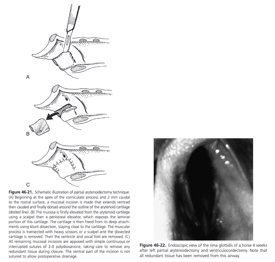 <ul><li><p><span>Dorsal recumbency under GA with endotracheal tube placed through a tracheotomy</span></p></li><li><p><span>Endoscope placed via the nostril with the tip positioned in the dorsal pharynx is useful for illumination of the surgical site, as is a headlamp</span></p></li><li><p><span>Ventral laryngotomy performed</span></p></li><li><p><span>For increased exposure, the cricoid cartilage can be split longitudinally, as can the body of the thyroid if needed</span></p></li><li><p><span>Submucosal injection of epinephrine helps to elevate the mucosal membrane and to control bleeding</span></p></li><li><p><span>Using a #15 scalpel, a dorsally based U-shaped mucosal flap is made overlying the arytenoid cartilage</span></p></li><li><p><span>Mucosal incision starts at the apex of the corniculate cartilage 2 mm caudal to the rostral surface and extends ventrad then caudad and finally dorsad around the outline of the arytenoid cartilage forming a three-sided U-shaped incision</span></p></li><li><p><span>If the mucosa on the luminal side of the arytenoid cartilage is not too compromised it is elevated started caudad and working rostrad toward the corniculate portion</span></p></li><li><p><span>A scalpel is used to sharply undermine the mucosal tissue initially, and then the dissection is completed with a periosteal elevator, leaving the dorsal mucosa attached</span></p></li><li><p><span>Lateral surface of the arytenoid cartilage is freed from its soft tissue attachments using blunt dissection, staying close to the cartilage, and the remaining mucosa over the rostral and lateral aspect of the corniculate cartilage is separated using sharp and blunt dissection</span></p></li><li><p><span>Arytenoid cartilage is elevated rostrally using Allis tissue forceps or a towel clamp and the muscular process is transected using heavy Mayo scissors or a scalpel</span></p></li><li><p><span>Any diseased or irregular cartilage attached to the muscular process dorsally is removed with rongeurs</span></p></li><li><p><span>Ventriculocordectomy is performed by incising the mucosa around the orifice of the ventricle and removing the entire saccule, followed by resection of the cord</span></p></li><li><p><span>Rostral and lateral corniculate mucosa is retracted slightly caudad and sutured with minimal tension to the leading rostrall edge of the mucosa flap using interrupted or continuous suture</span></p><ul><li><p><span>Obliteration of the piriform recess should be avoided by not pulling the leading edge of this tissue caudal to the palatopharyngeal arch</span></p></li></ul></li><li><p><span>Remainder of the mucosal flap is sutured to the adjacent laryngeal mucosa similarly but leaving the ventral part of the incision open for drainage</span></p></li><li><p><span>Ventriculocordectomy incisions are not sutured</span></p></li><li><p><span>Large mucosal defects are left unsutured to heal by second intention, and the corniculate mucosa is sutured laterally to the remaining soft tissues</span></p></li><li><p><span>If the cricoid cartilage was divided the two sides are brought into close apposition by suturing the soft tissues immediately ventral to the cartilage ends in a simple interrupted or cruciate pattern</span></p><ul><li><p><span>Don't place sutures through the cartilage to prevent chondroma formation</span></p></li></ul></li><li><p><span>Laryngotomy left unsutured because of possibility of laryngeal edema and subsequent airway obstruction</span></p></li><li><p><span>Food is withheld for 24 hours at which time the larynx is evaluated endoscopically and airway patency is assessed</span></p></li><li><p><span>When feed is reintroduced at 24 hours, only wet hay should be fed from the ground until the horse is able to swallow without coughing</span></p></li><li><p><span>Stall rest for 4-6 weeks prior to complete healing which usually occurs within 8-10 weeks</span></p></li><li><p><span>In clinical cases, 62% of Thoroughbreds raced successfully after the treatment of unilateral arytenoid chondropathy</span></p></li></ul>