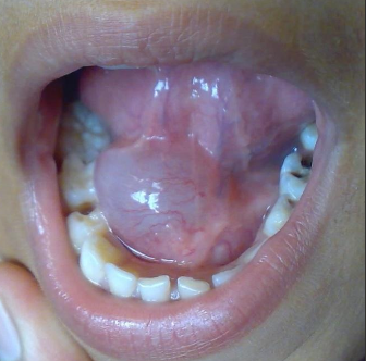 <p>How would you manage a ranula?</p>