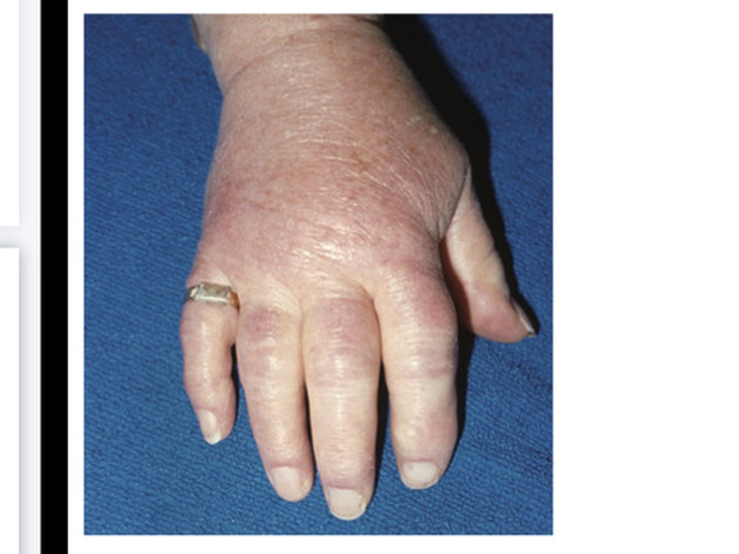 <p>Severe hypothyroidism</p><p>with swelling of subcutaneous tissues</p><p>Typically around eyes and the backs of the hands</p><p>Often has a purplish tinge Tight rings</p><p>Tight rings</p>