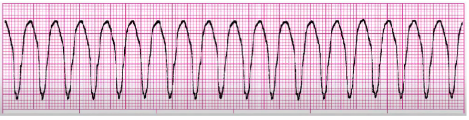 <p>follow algorithm:</p><p>pulse and stable: 02, IV access, anti-arrhythmics</p><p>pulse and unstable: O2, cardiovert (sedate prn), antiarrhythmics</p><p>no pulse: treat as vfib</p><p>chronic: PO meds, ICD, ablation</p>