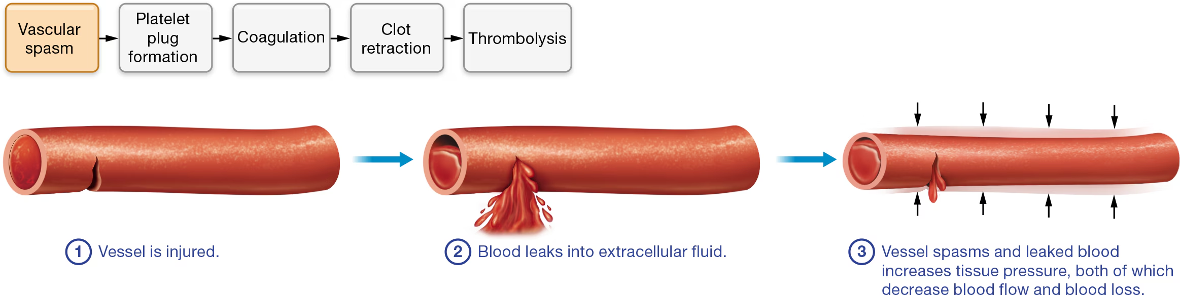 <p><strong>①</strong> a blood vessel is injured and <strong>②</strong> blood leaks into extracellular fluid, two immediate responses occur: <strong>③</strong> spasm of the vascular smooth muscle and increased tissue pressure. Both responses decrease the blood vessel diameter.</p>
