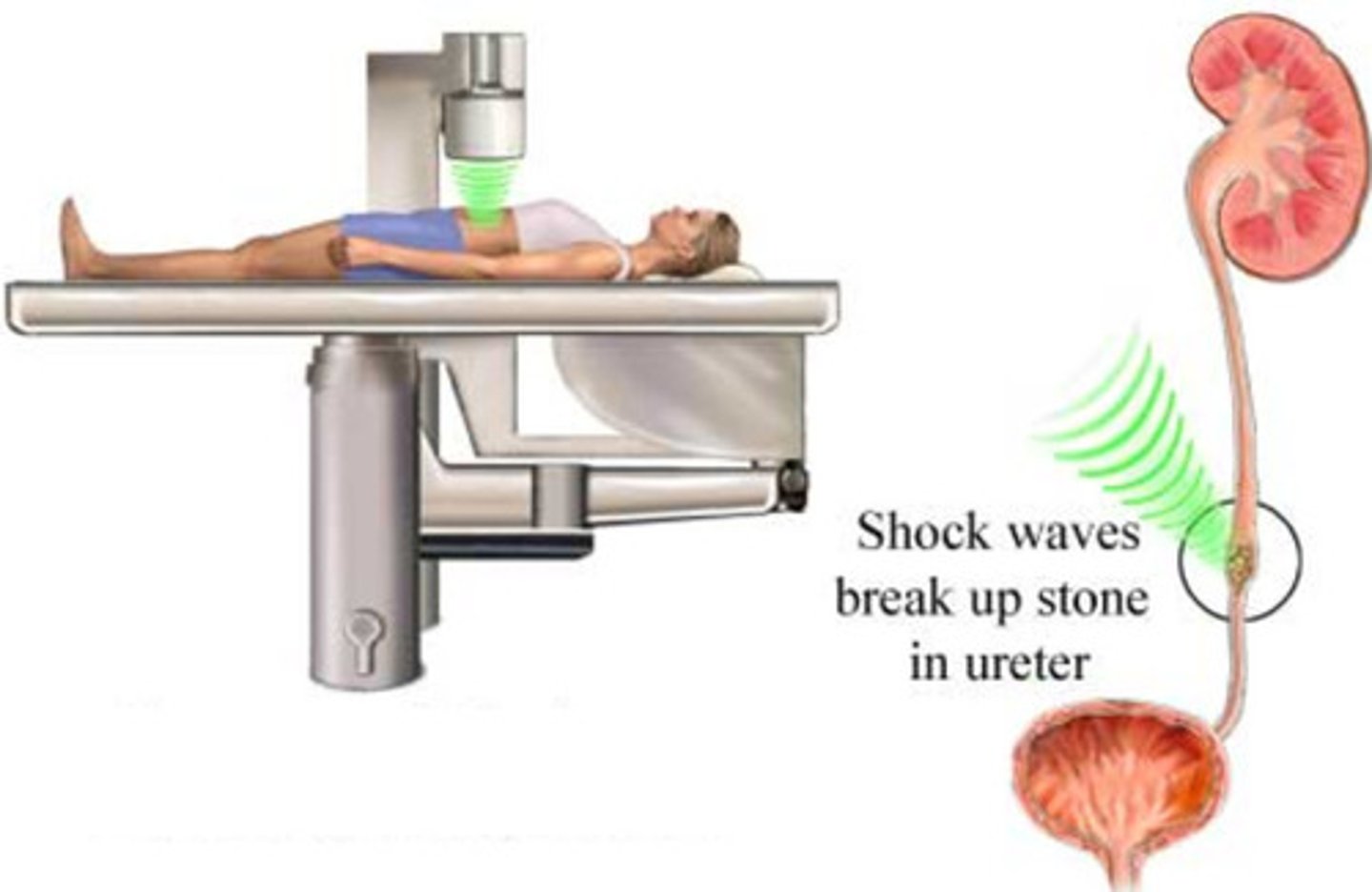 <p>Lithotripsy</p><p>ureteroscopy</p><p>percutaneous extraction</p>