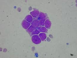 Figure 22: Retinoblastoma