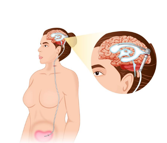 ○ Ventricle - Space in the brain 

○ Peritoneum - Serous membrane  lining the abdominal  compartment  

○ Shunt that drains extra CSF  from brain to the abdomen,  where it can then be excreted  as urine.  