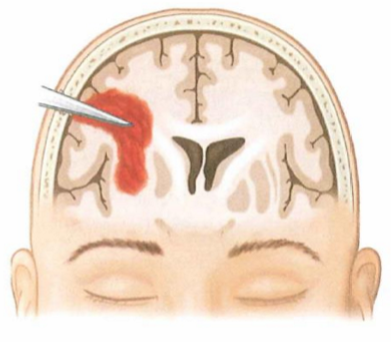 <p>Open head injury</p><ul><li><p>foreign object breaks through skull, punctures meninges and enters the brain, pushes bone fragments into brain below fracture</p></li><li><p>Impairments often focal (localised) rather than diffuse</p></li></ul><p></p>