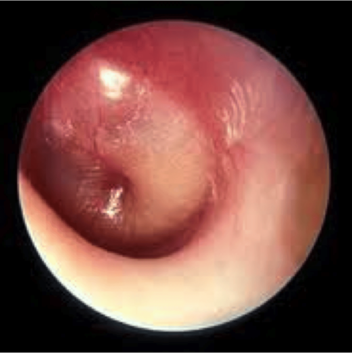 <p>AOM</p><p>bulging and erythematous TM</p>