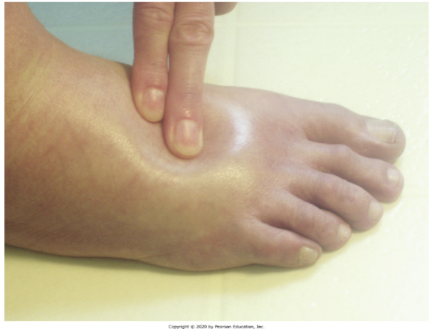 <p>Swelling from excessive amounts of fluid that move from the blood into the dermis or subQ.</p>