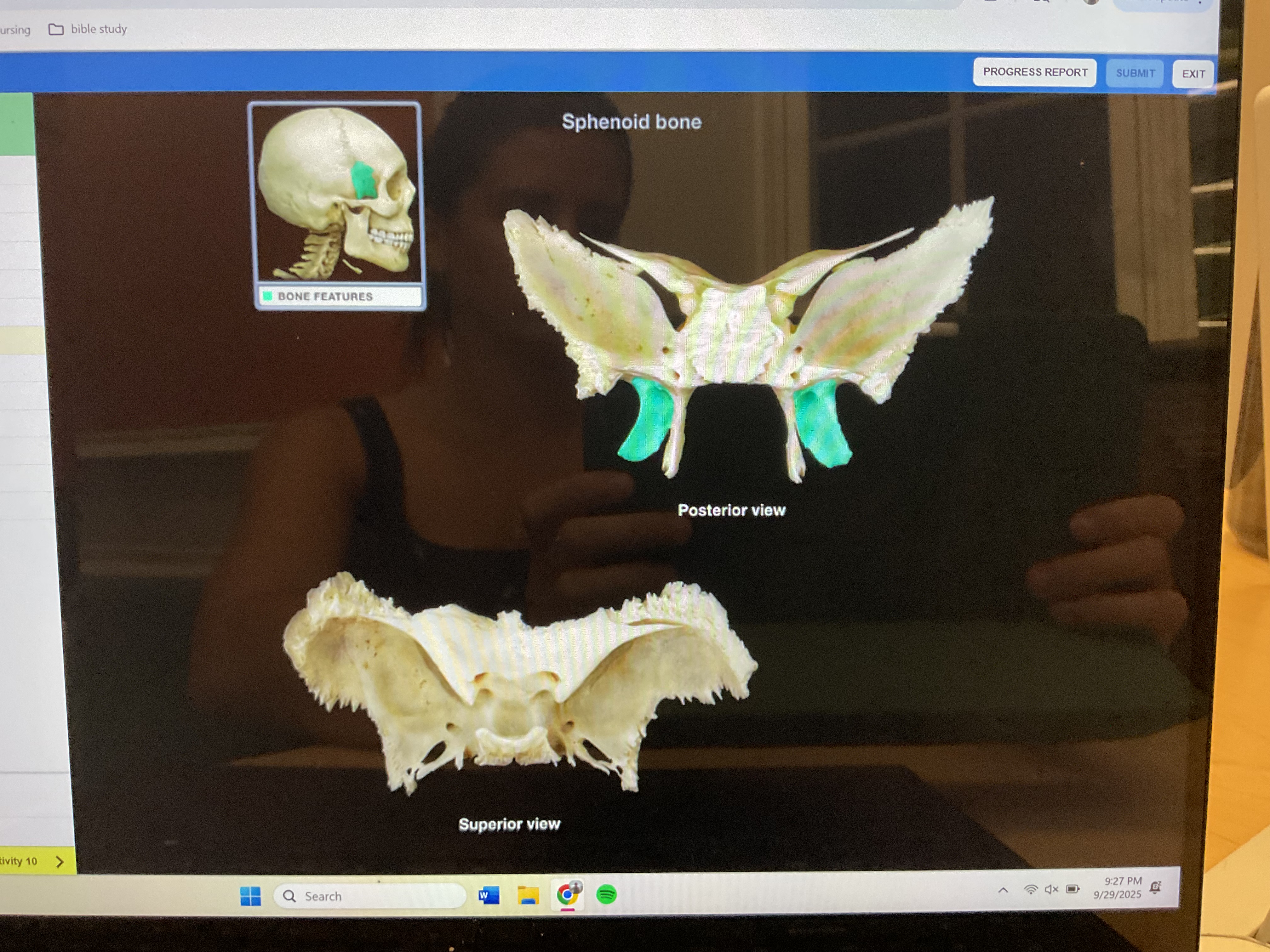 <p>Lateral pterygoid plate </p>