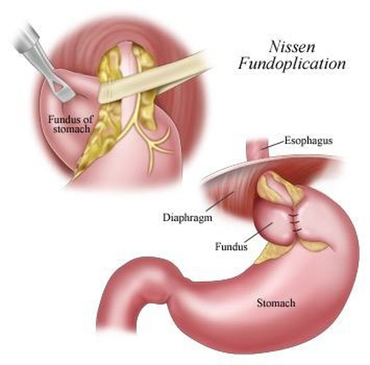 <p>A surgical procedure where the upper curve of the stomach is wrapped around the esophagus to create a new valve.</p>