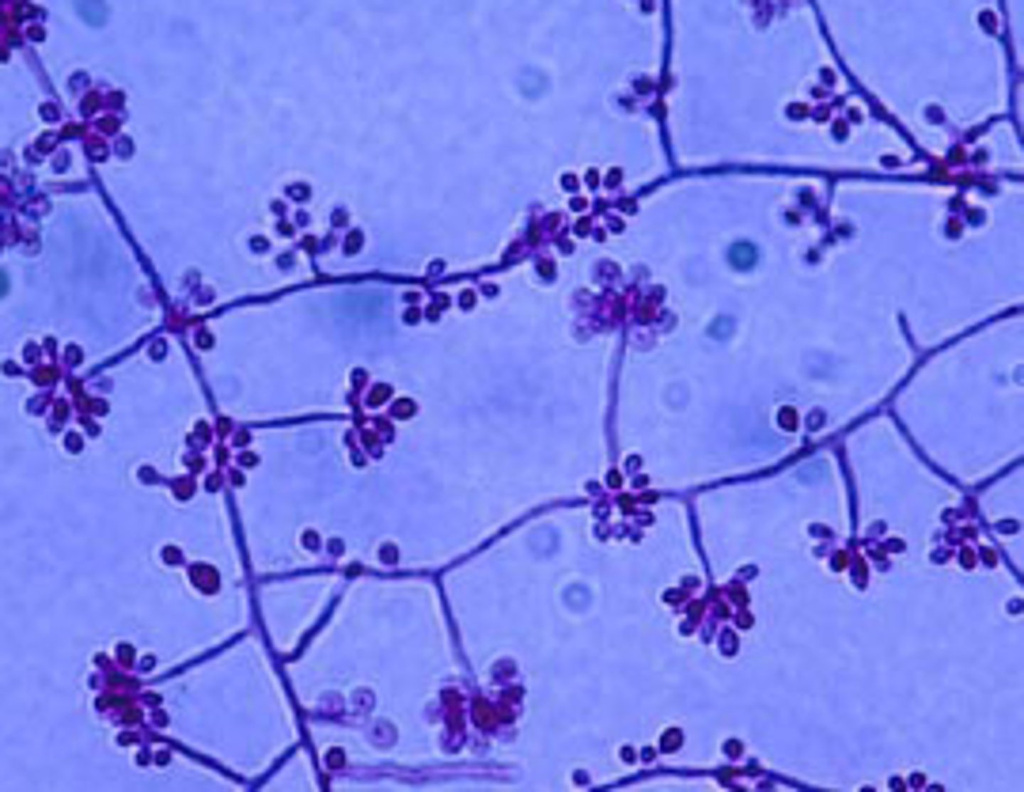 <p>• Causes "rose gardener's disease"</p><p>• Yeast: cigar shaped, narrow based</p><p>• Mold: hyaline, septate hyphae with</p><p>"rosettes" of microconidia</p>