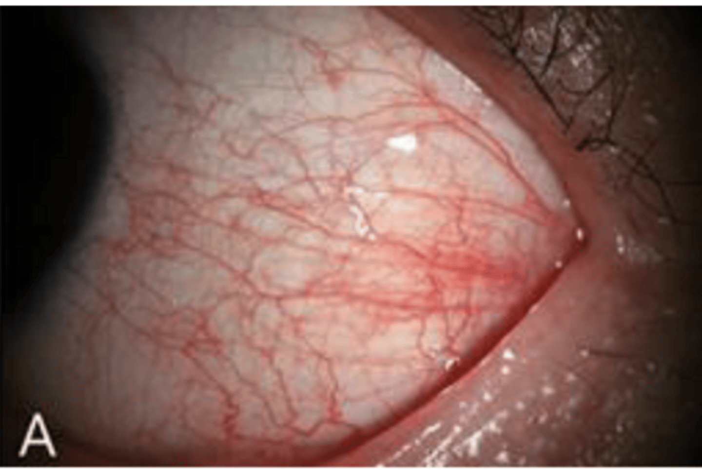 <p>What grade would you assign to this conjunctival hyperemia?</p>