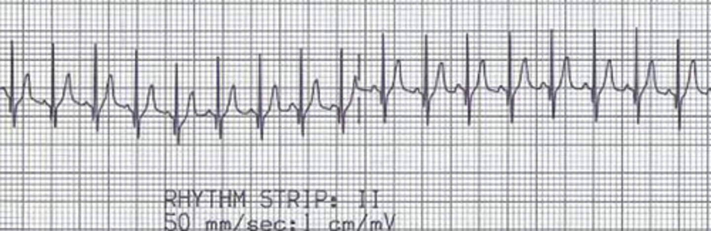 <p>What is this ECG showing?</p>