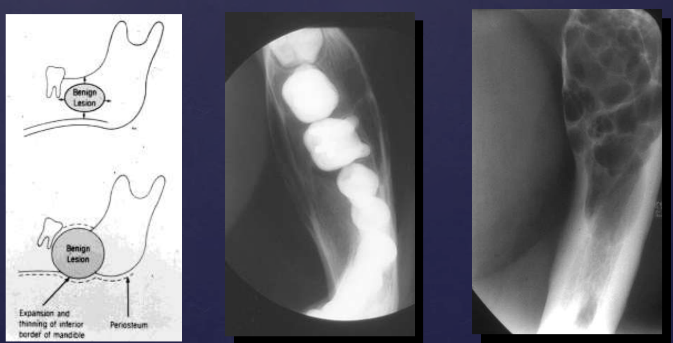 <ul><li><p>expansion</p></li><li><p>thinning</p></li><li><p>erosion (in case of aggressive benign lesions)</p></li></ul><p></p>