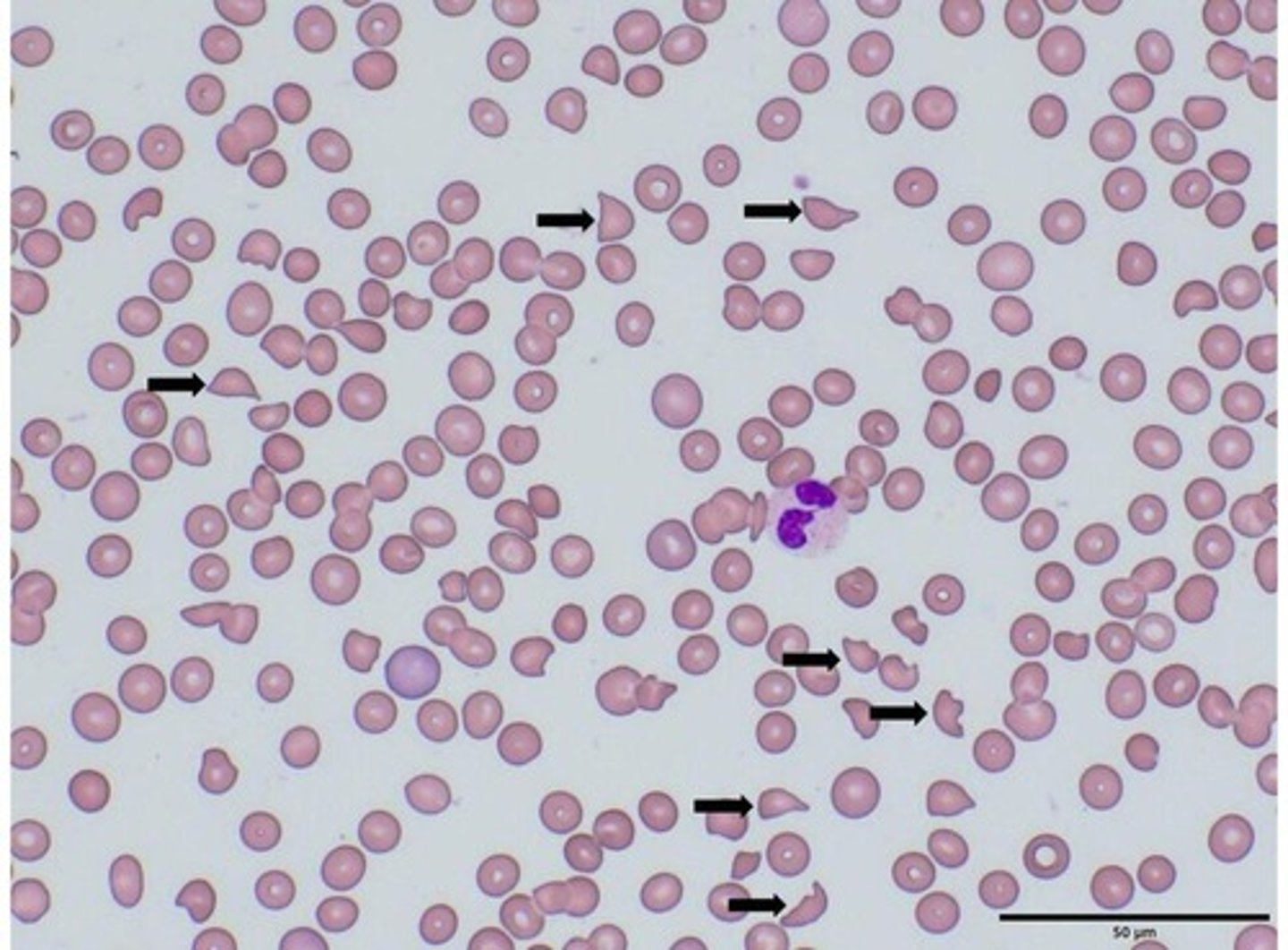 <p>Fragmented red blood cells indicating damage.</p>
