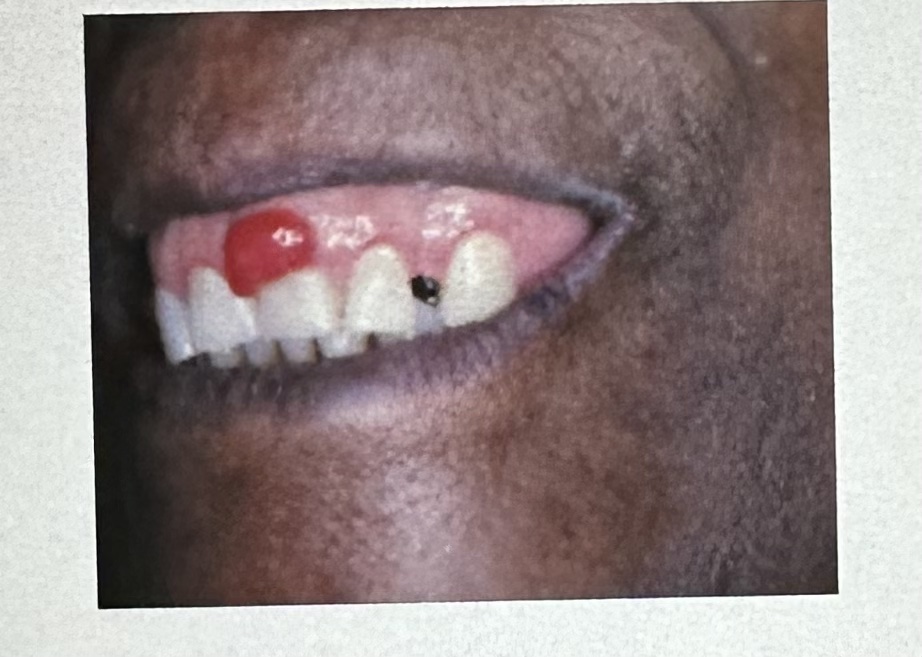 <p><span>This sessile-based lesion is on the gingiva of a 13-year -old female. It is soft to palpation and bleeds easily.</span><br><br><span>A. peripheral giant cell granuloma</span><br><span>B. pyogenic granuloma</span><br><span>C. traumatic neuroma</span><br><span>D. irritation fibroma</span></p>