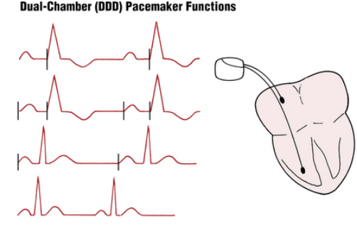 <p>what is it called when the pacemaker feels that the atria/ventricle contracted on its own + when it has to shock it to get it to move?</p>