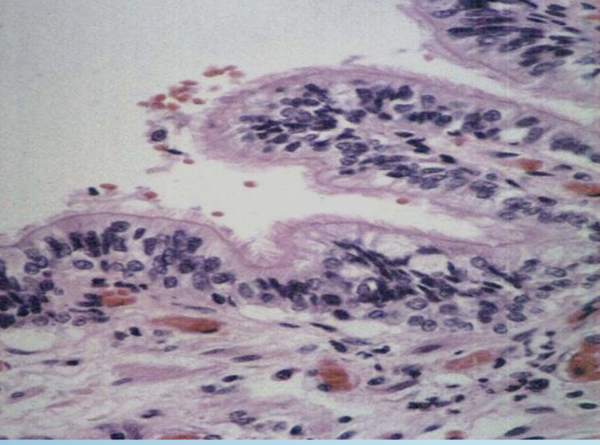 <p>Replacement of ciliated columnar epithelium with stratified squamous cells in smokers.</p>