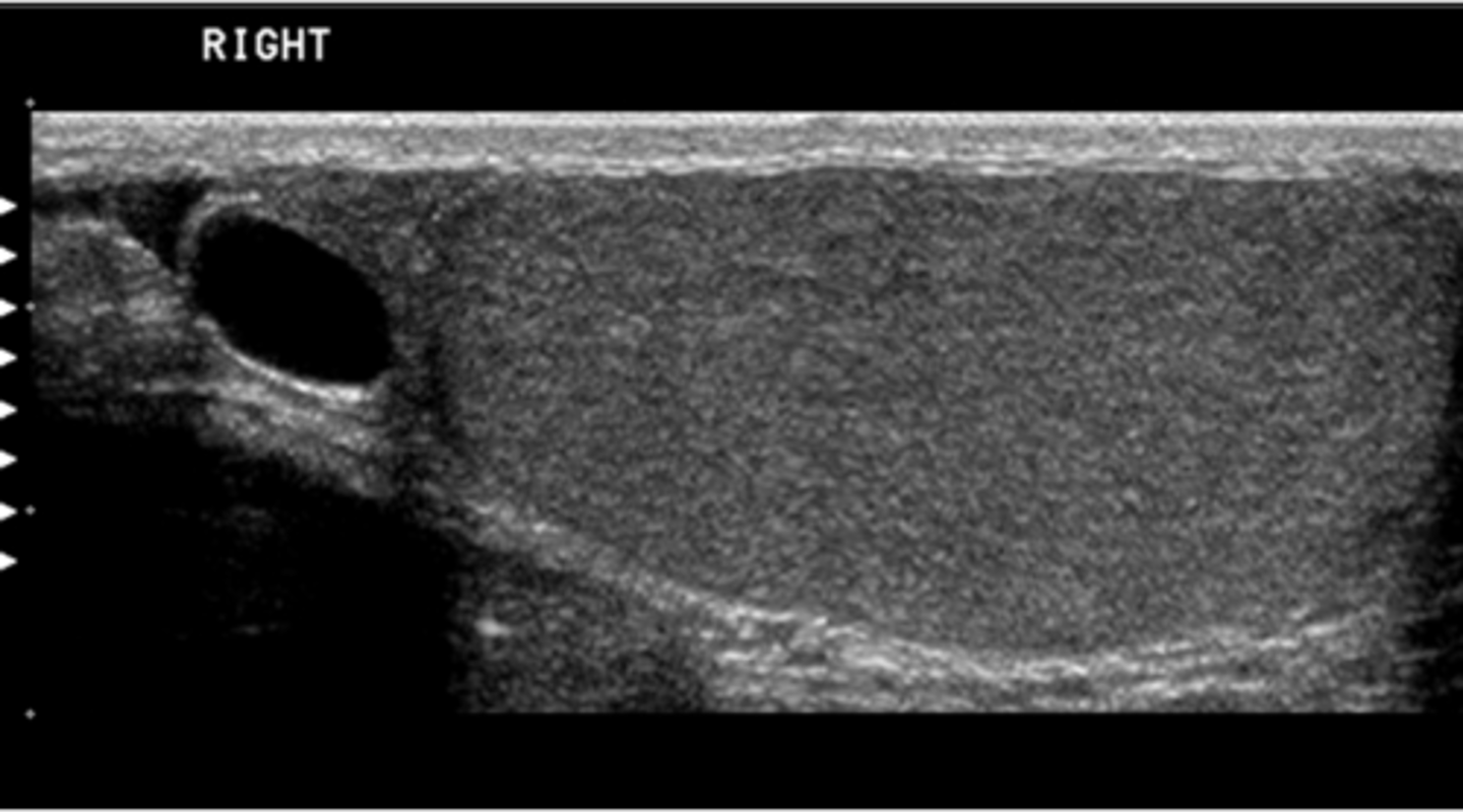 <p>You have obtained this image while performing a scrotal ultrasound on a patient with a history of a palpable right sctrotal mass. What pathology is present?</p><p>a. seminoma</p><p>b. epididymal cyst</p><p>c. epididymitis</p><p>d. orchitis</p><p>e. hydrocele</p>