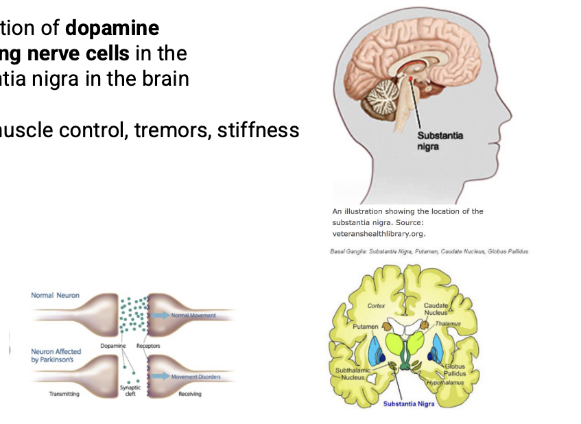 <ul><li><p>degeneration of <strong>dopamine producing nerve cells</strong> in the <u>substantia nigra</u></p></li><li><p>loss of muscle control, tremors, stiffness</p></li></ul><p></p>