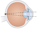 <p>Is this Myopia or Hyperopia? How can it be corrected?</p>
