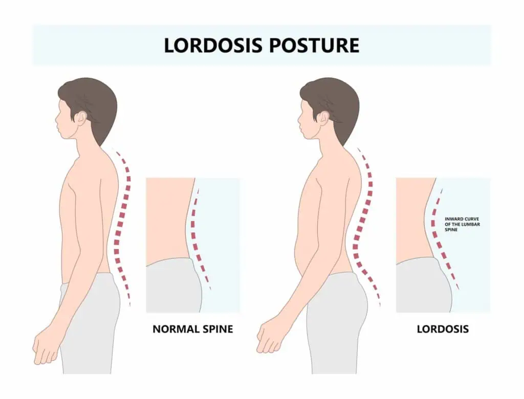 <p>Happens from pressure from big belly on lower back, Anterior deviation in lumbar secondary curvature&nbsp;</p>