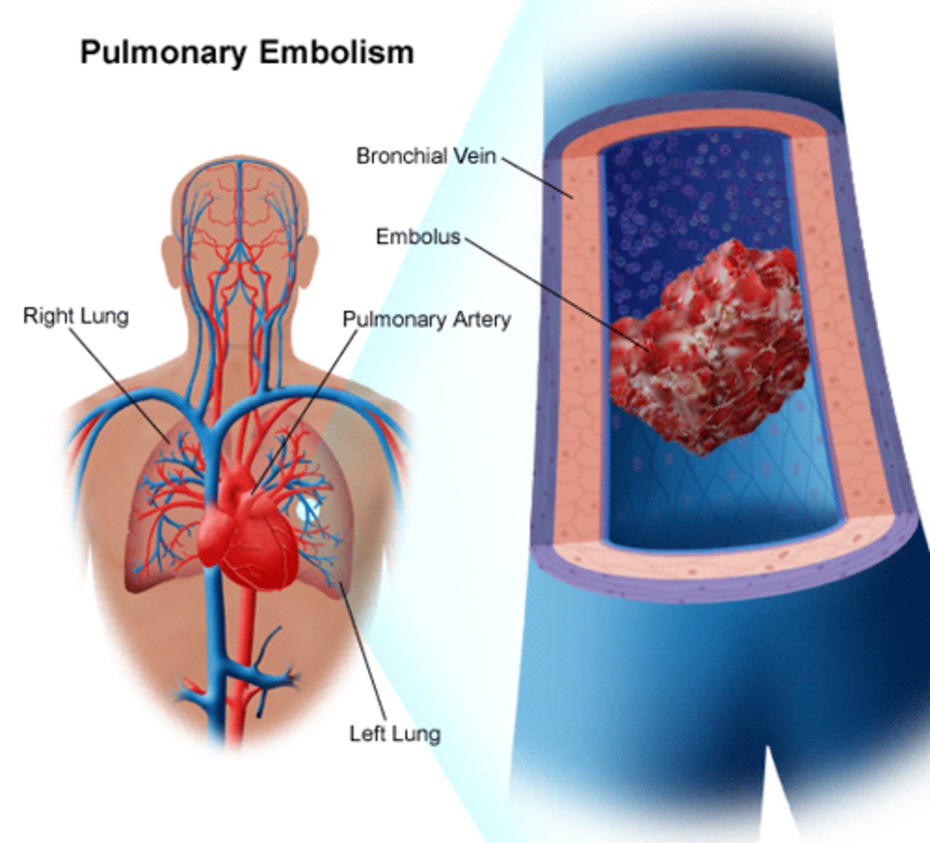 <p>When an embolus (a moving blood clot) lodges within a vessel and blocks the flow of blood</p>