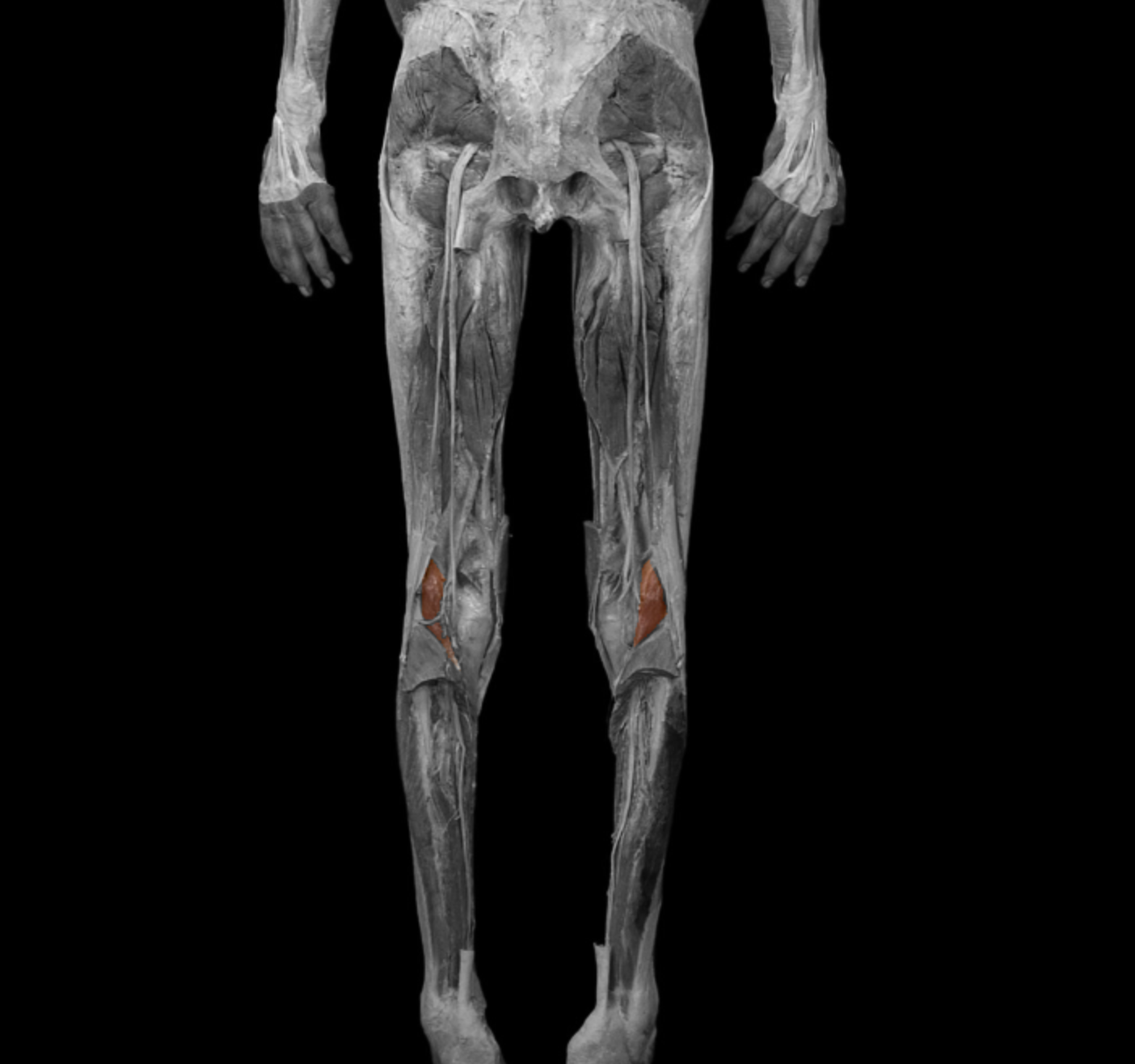 <p>origin: lateral epicondyle of femur </p><p></p><p>insertion: calcaneus (medial to achilles) </p><p></p><p>action: plantar flex, flex leg at knee </p><p></p><p>innervation: tibial nerve </p>