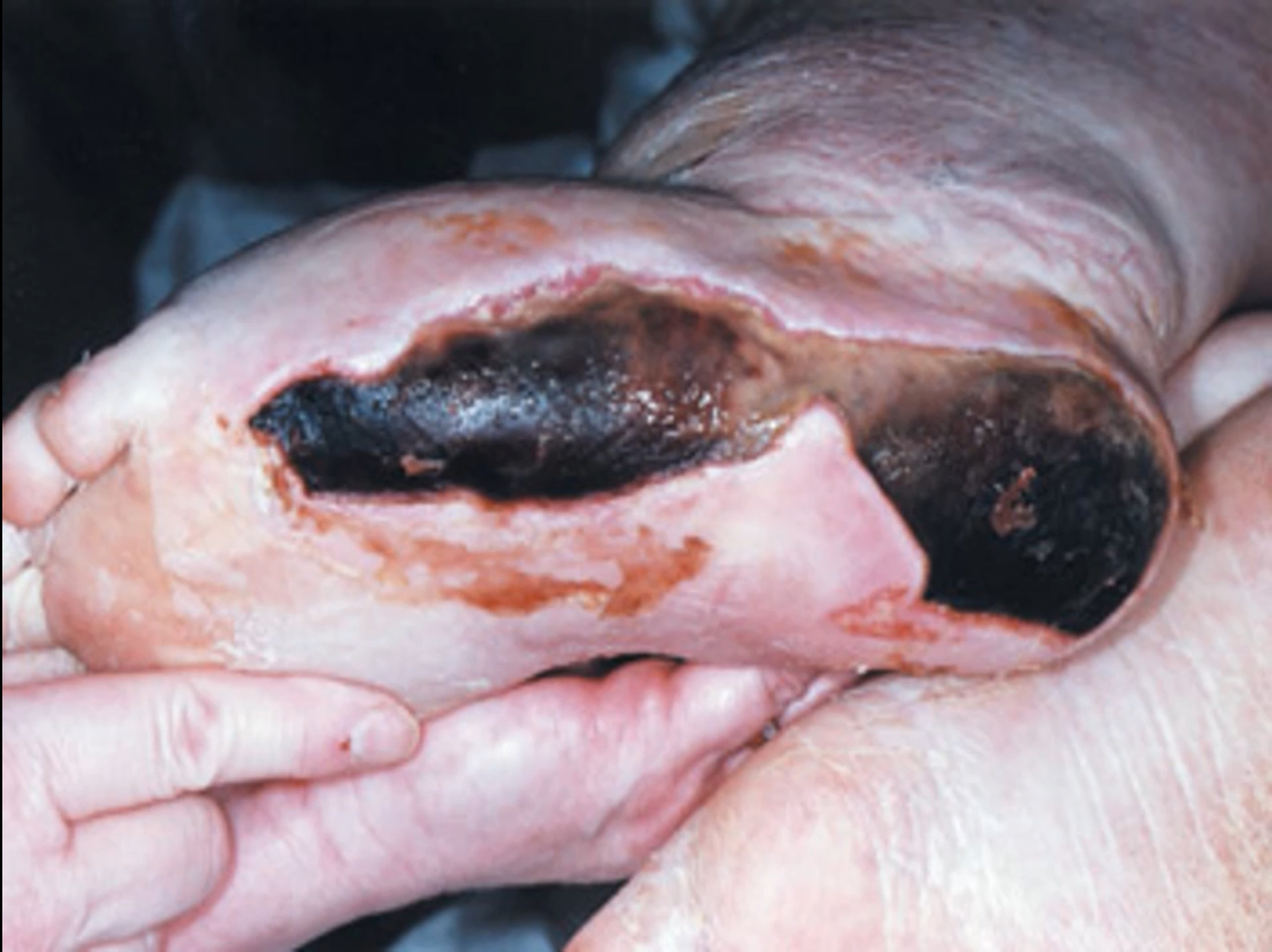 <p>Eshar = fully black, slough in the middle of the wound, has clean edges so may be beginning to heal </p>