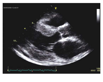 <p>What is the PSLA view best for measuring regarding the Left Ventricle (LV)?</p>