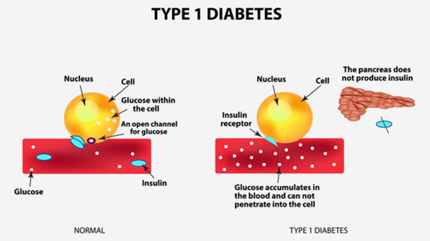 <p>- increased glucose in plasma (hyperglycemia) => high solute concentration (hypothalamus stimulates polydipsia/excessive thirst to try and dilute)</p><p>=> osmotic shift of fluid into circulation = cellular dehydration</p><p>- high solute concentration in renal tubules => Osmotic shift into filtrate = high urine production (polyuria stimulated)</p><p>- **Therefore: hyperglycemia, polydipsia, polyuria, glycosuria (hallmarks of DM I)</p>