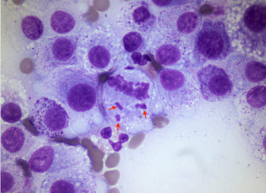 <p>Criteria of malignancy - Nucleoli</p><p>Describe the cell - malignant or no? Why?</p>