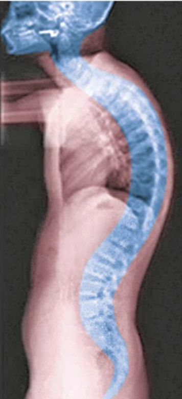 <ol><li><p><span style="background-color: transparent; font-family: &quot;Times New Roman&quot;, serif;"><span>Exaggerated thoracic curvature</span></span></p><ol><li><p><span style="background-color: transparent; font-family: &quot;Times New Roman&quot;, serif;"><span>Ex. hunch back</span></span></p></li></ol></li></ol><p></p>