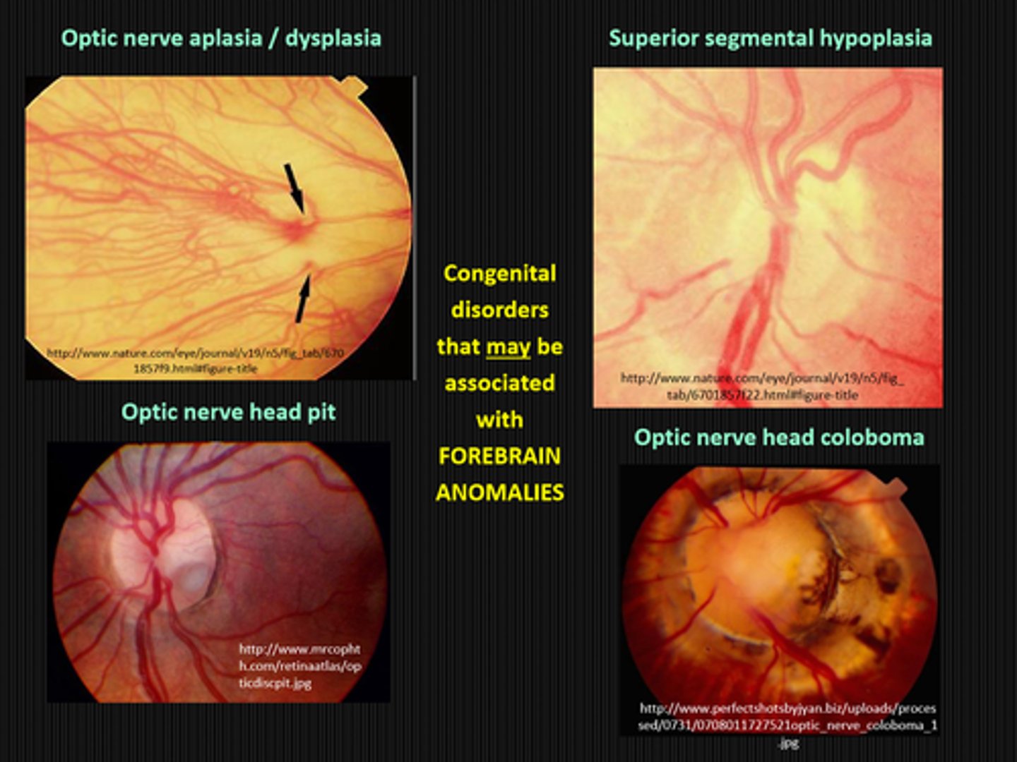 <p>ON aplasia/dysplasia</p><p>ONH pit</p><p>sup segmental hypoplasia</p><p>ONH coloboma</p>