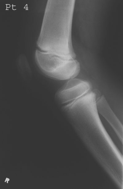 <p>Joint effusion, clicking, locking, tenderness.</p>