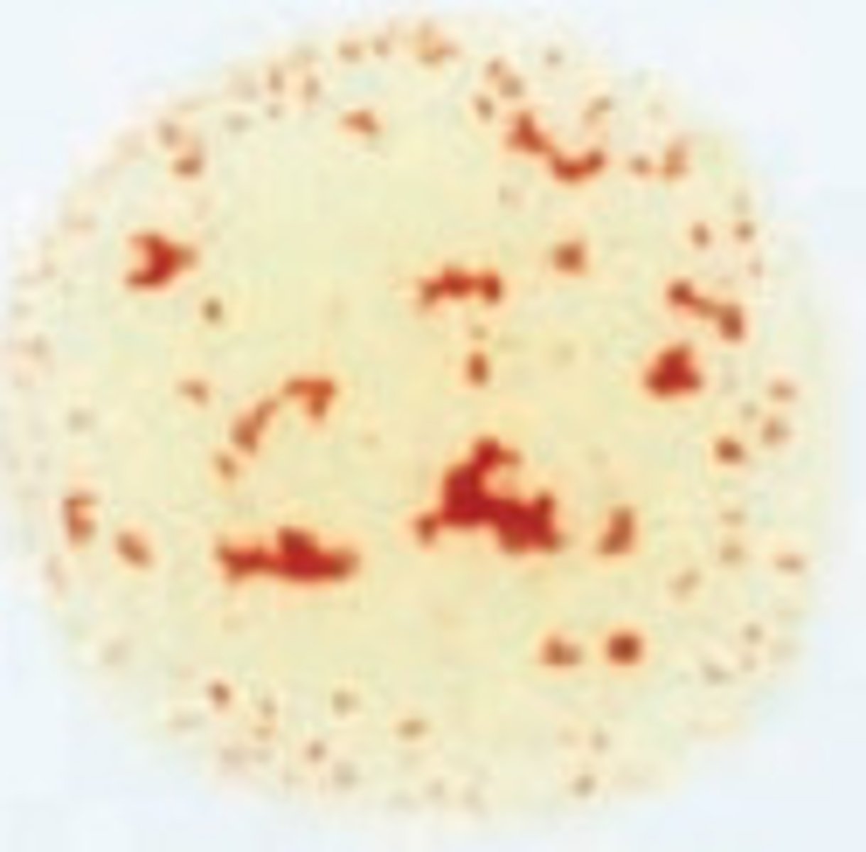 <p>When you add anti-serum B to Blood type AB you have agglutination.</p>
