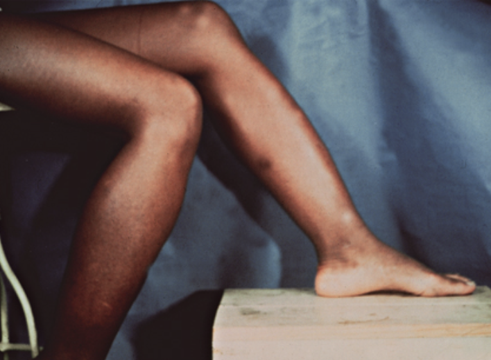 <p>Adolescente com sífilis congênita. Qual a alteração evidenciada na imagem?<br></p>