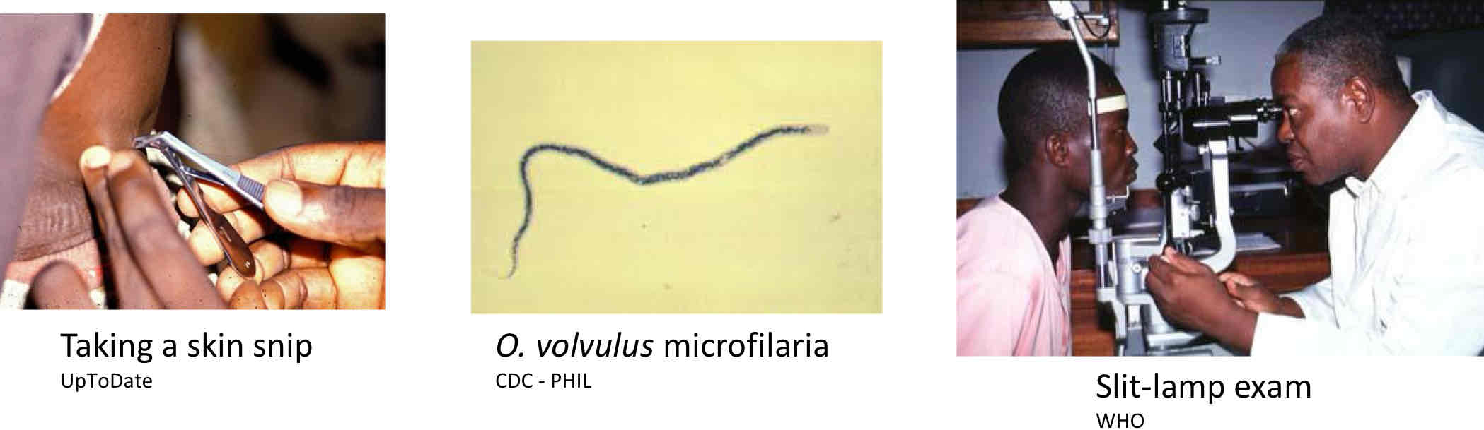 <ul><li><p>Clinical presentations &amp; patient Hx</p></li><li><p>Microscopy - skin snips or nodule biopsy</p></li><li><p>Slit-lamp eye exam </p></li><li><p>Ultrasound</p></li></ul>