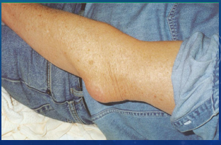 <p><strong>Olecranon Bursitis: Background</strong></p><p>-Inflammation of the _____ that overlies the __________ process</p><p>-Mechanism of Injury: </p><ul><li><p>_____</p></li><li><p>Prolonged _________ to area (think truck driver resting on elbow)</p></li><li><p>_________ or strenuous act</p></li><li><p>Crystal induced arthropathy </p></li><li><p>Inflammatory arthritis (__)</p></li><li><p>Septic bursitis </p></li></ul><p>-S/S:</p><ul><li><p>TTP and ___________ over the olecranon</p></li><li><p>Can be red and warm and appear like _____________</p></li></ul><p></p>