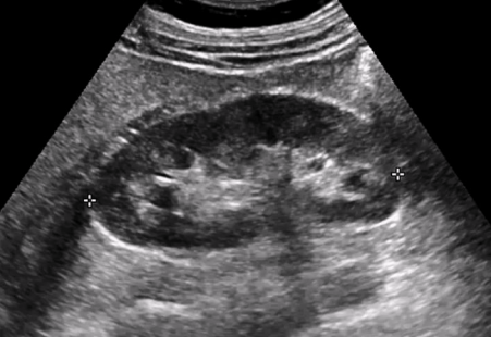 <ul><li><p>Normal renal cortex has homogeneous echotexture in adults and children</p></li><li><p>It is hypoechoic to the liver, spleen, renal sinus</p><ul><li><p>It can still be considered normal if it is isoechoic with liver &amp; spleen</p></li></ul></li><li><p>In neonates, the renal cortex is normally isoechoic or hyperechoic compared to the adjacent liver or spleen</p></li></ul><p></p>