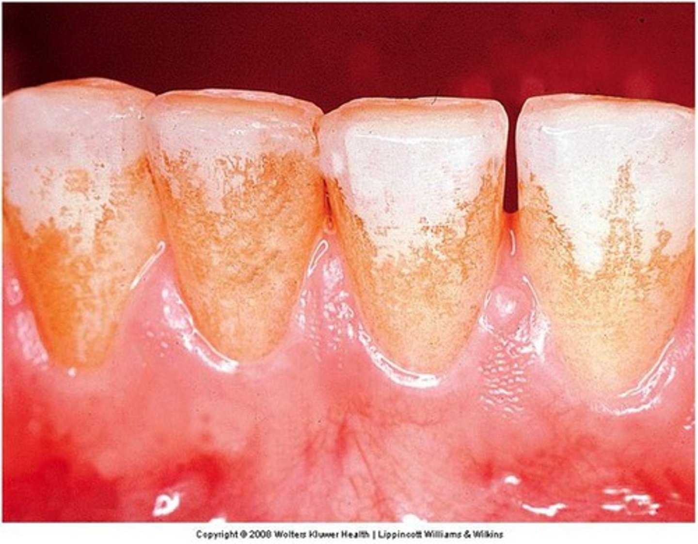 <p>• tooth staining</p><p>• altered taste</p><p>• calculus formation</p>