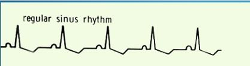 <p>regular sinus rhythm</p>